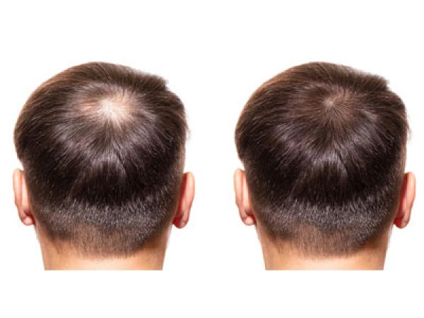 Saç lazeri | Saç mezoterapisi